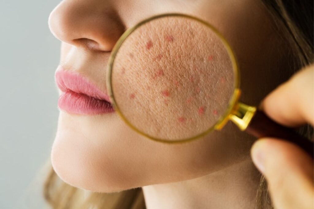 acne